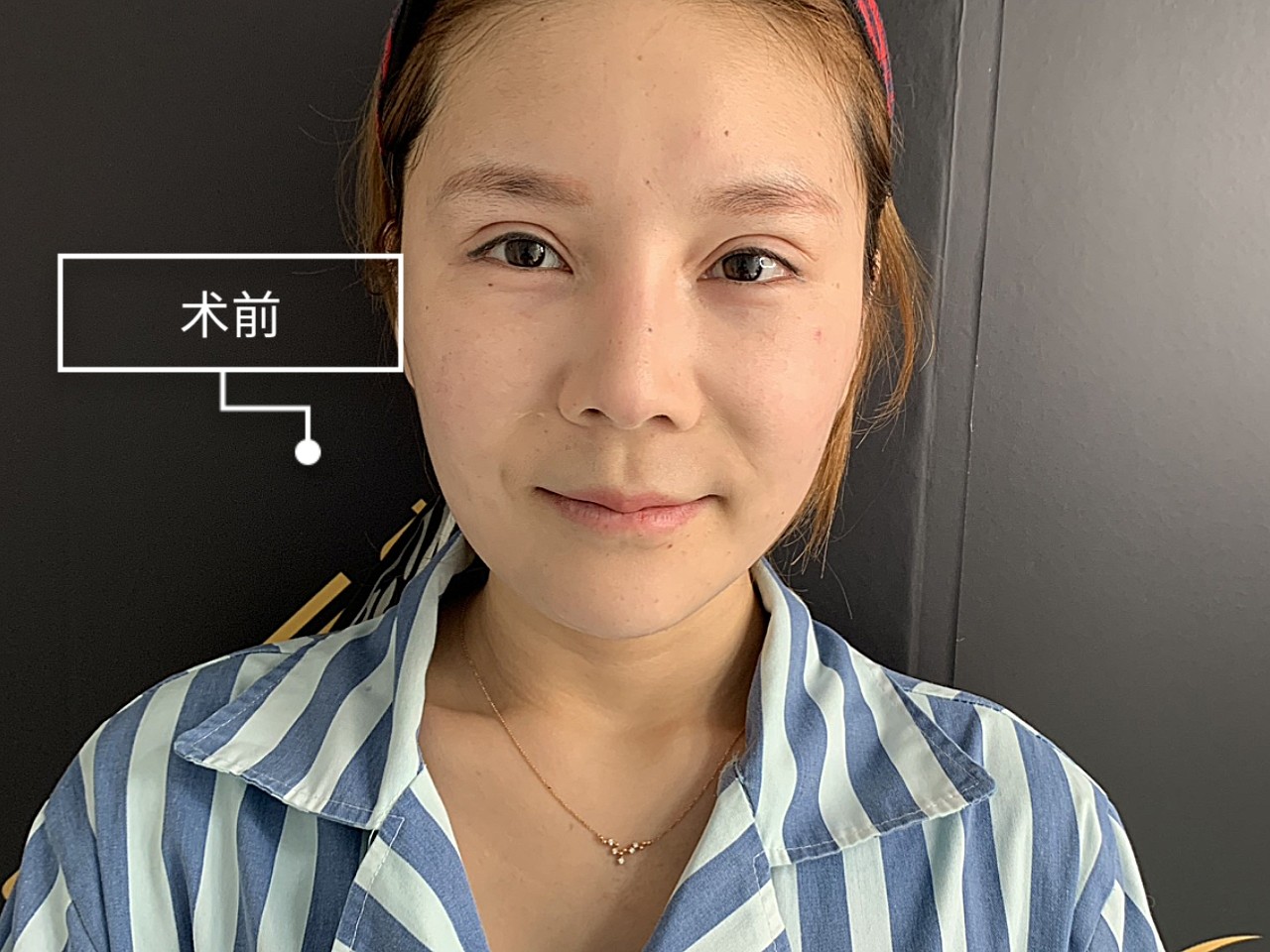 术前诊断术前诊断:宝宝术前苹果肌下垂,想要恢复苹果_圈子-新氧美容