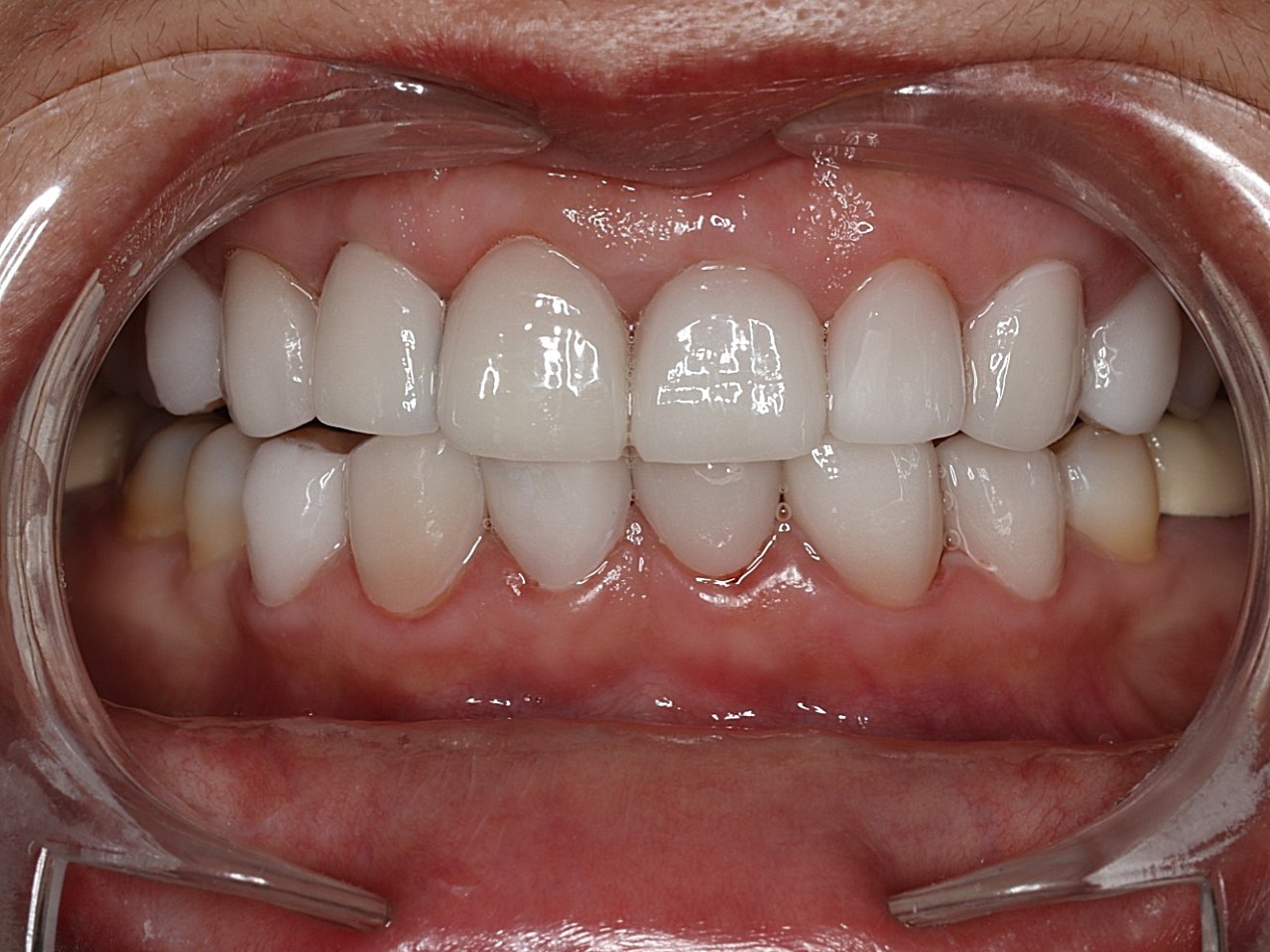 其实很早就想做牙贴面了,最近也是身边有姐妹去做了之后,看她们的变化