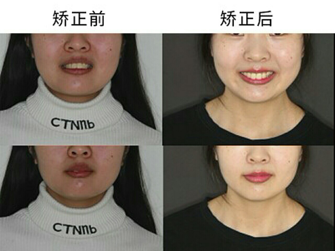 口内照片显示,上下牙弓都偏窄,弓形不协调,前牙深覆_圈子-新氧美容