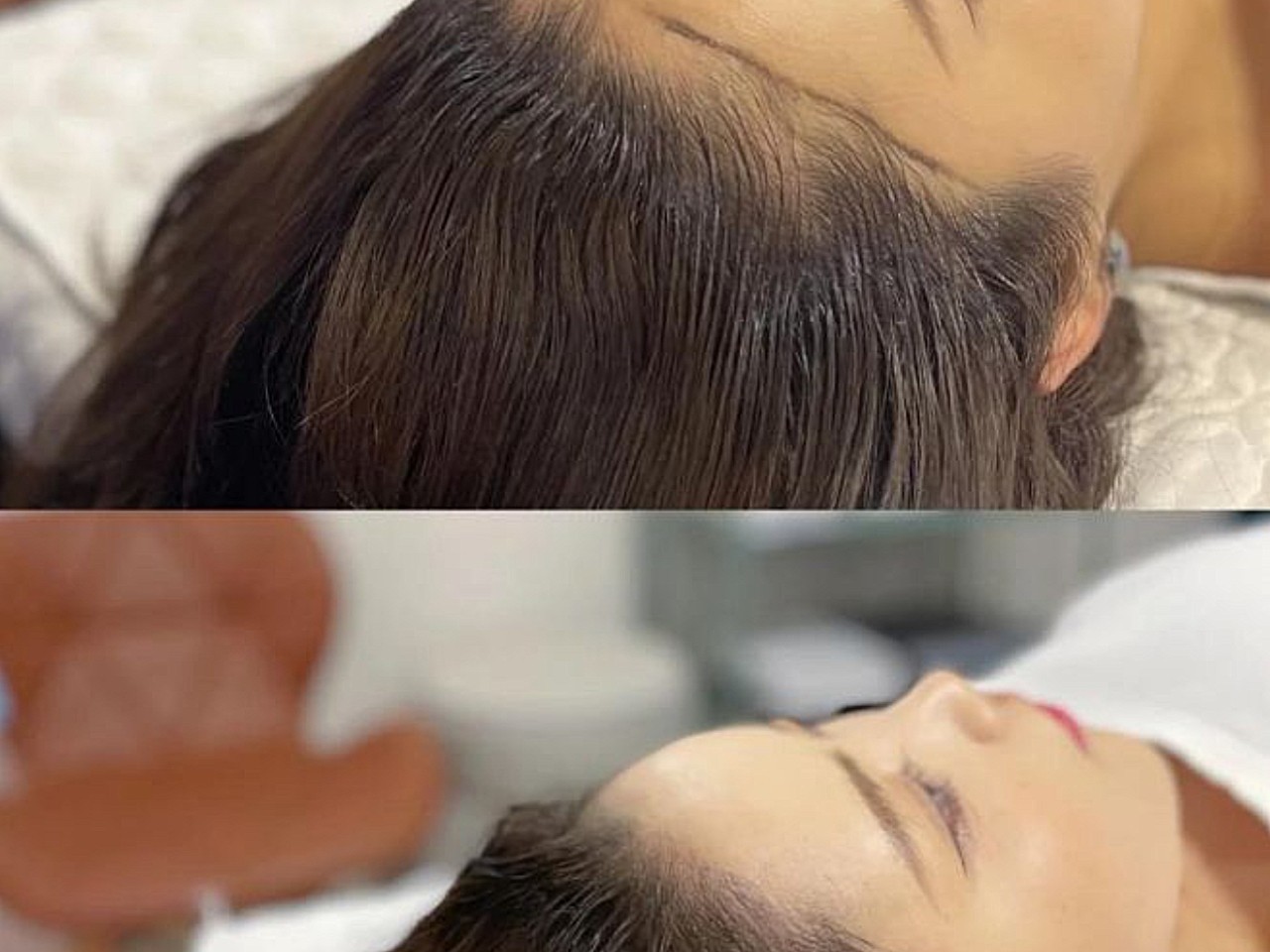 经过半永久纹发际线已经快两个星期了,现在看起来还是_圈子-新氧美容