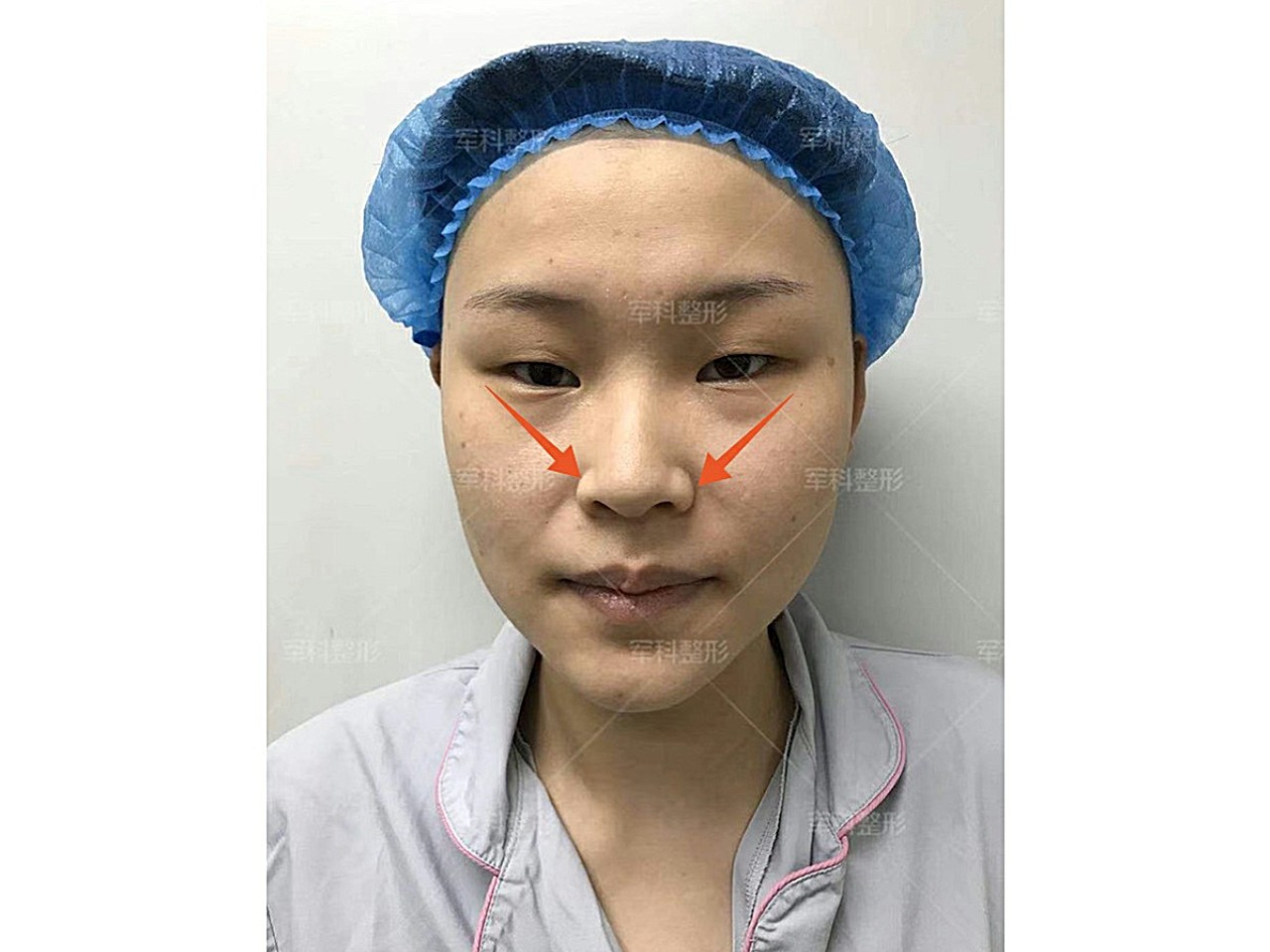 术前分析求美者术前鼻翼外扩偏宽就算不做表情的时候也像在生气一样