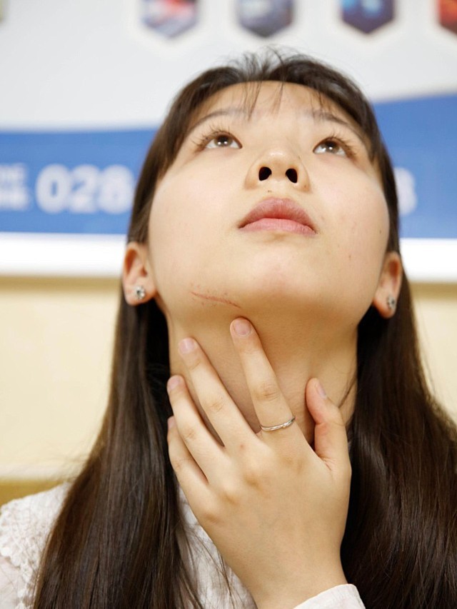 骑自行车不注意磕到了下颌位置,缝针后留下了一道细长_圈子-新氧美容