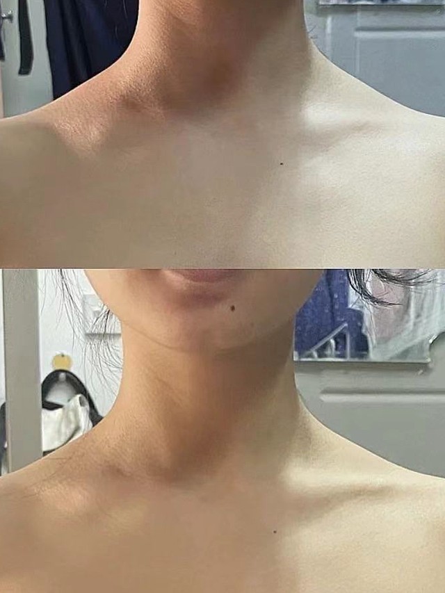 打了瘦肩针一个月啦,多多少少还有点效果的,因为