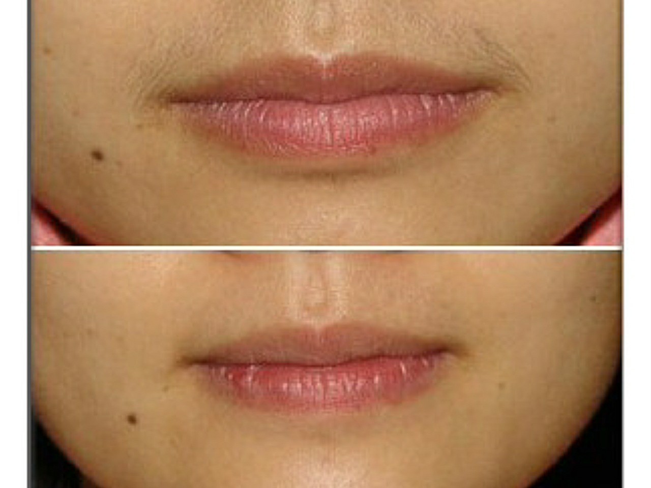 【激光脱毛】脱腋毛 1次 ,兰州皙妍丽 激光脱毛 唇毛/腋毛二选一