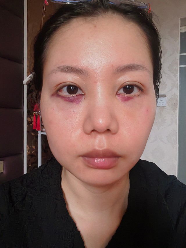 先说说手术过程吧,真的挺快的,除了麻药那一下,其