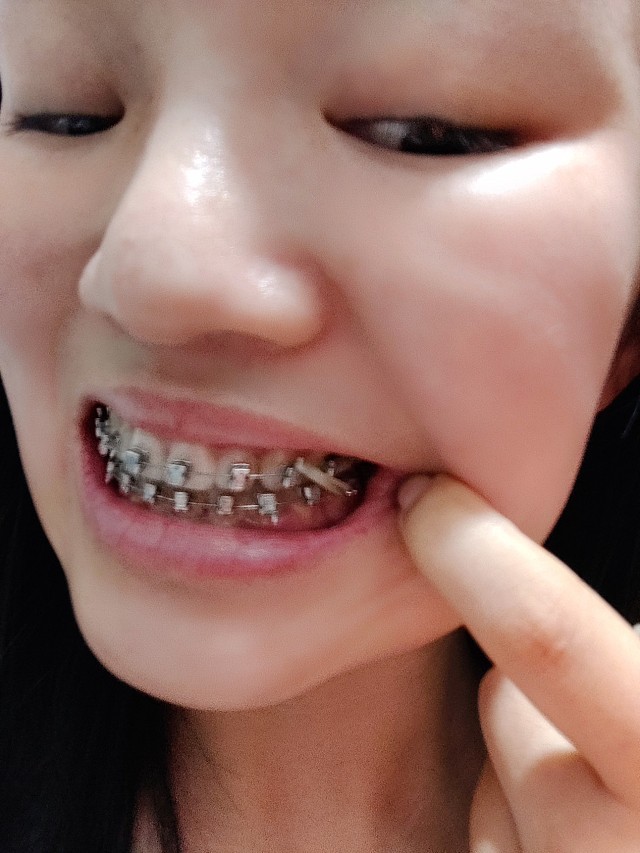这次依然还是调整牙齿的咬合阶段,左侧有一颗牙倒扣着_圈子-新氧美容