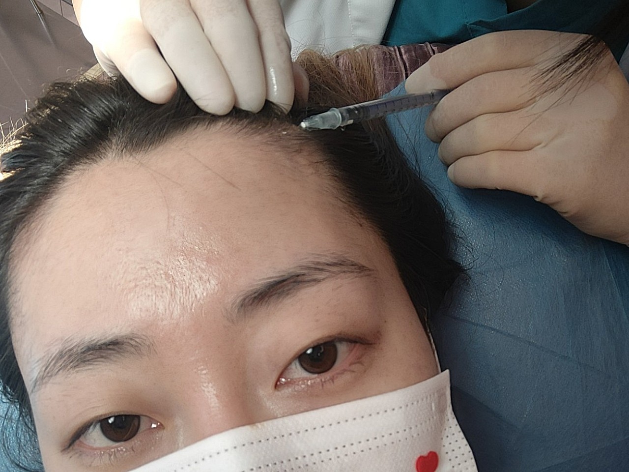 [:163]体验前变美诉求:m区发际线的部分,注射_圈子-新氧美容整形