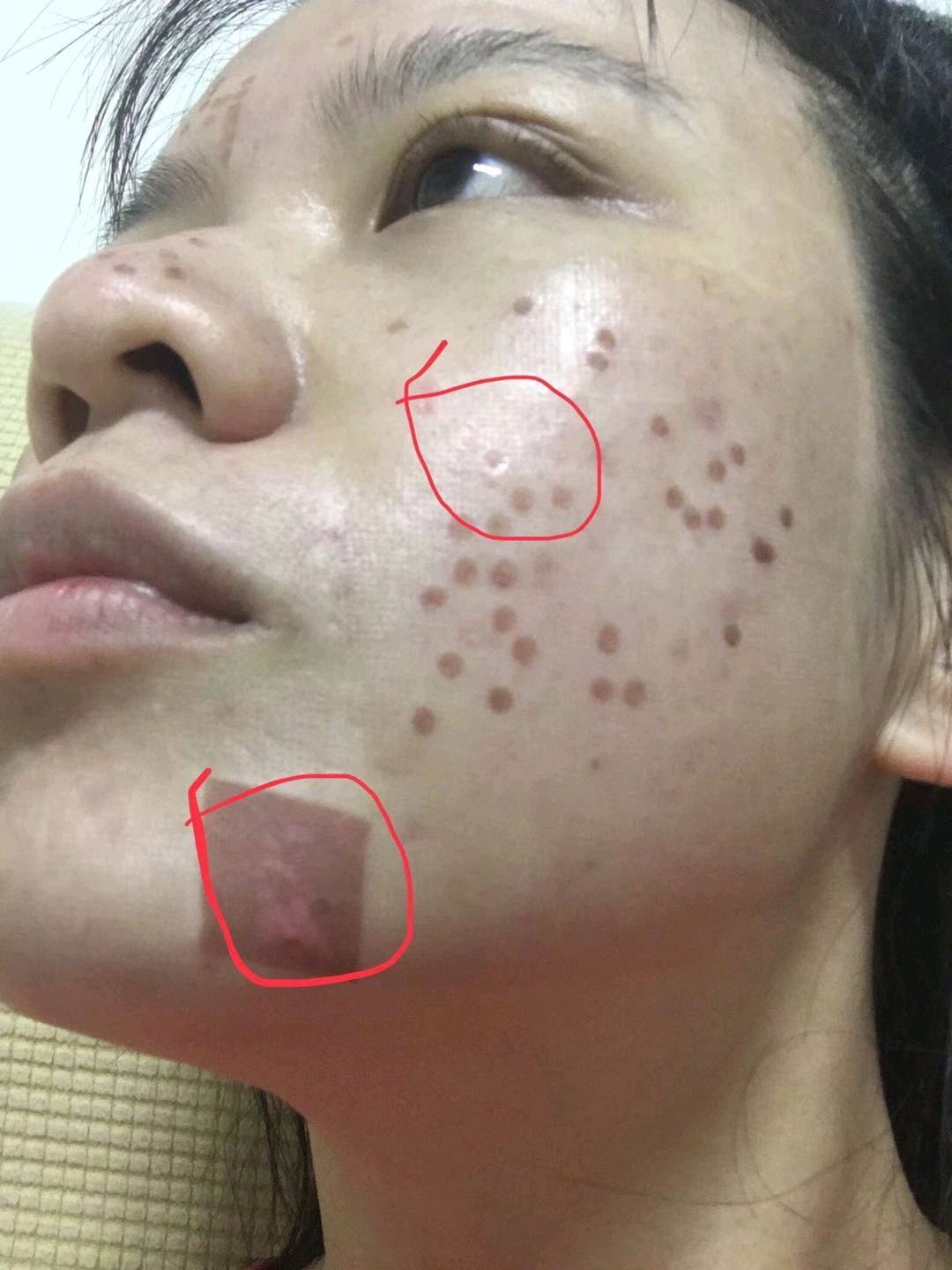 做完点阵激光脸上被烫伤一块怎么办结痂掉了以后留下更深的坑能恢复吗
