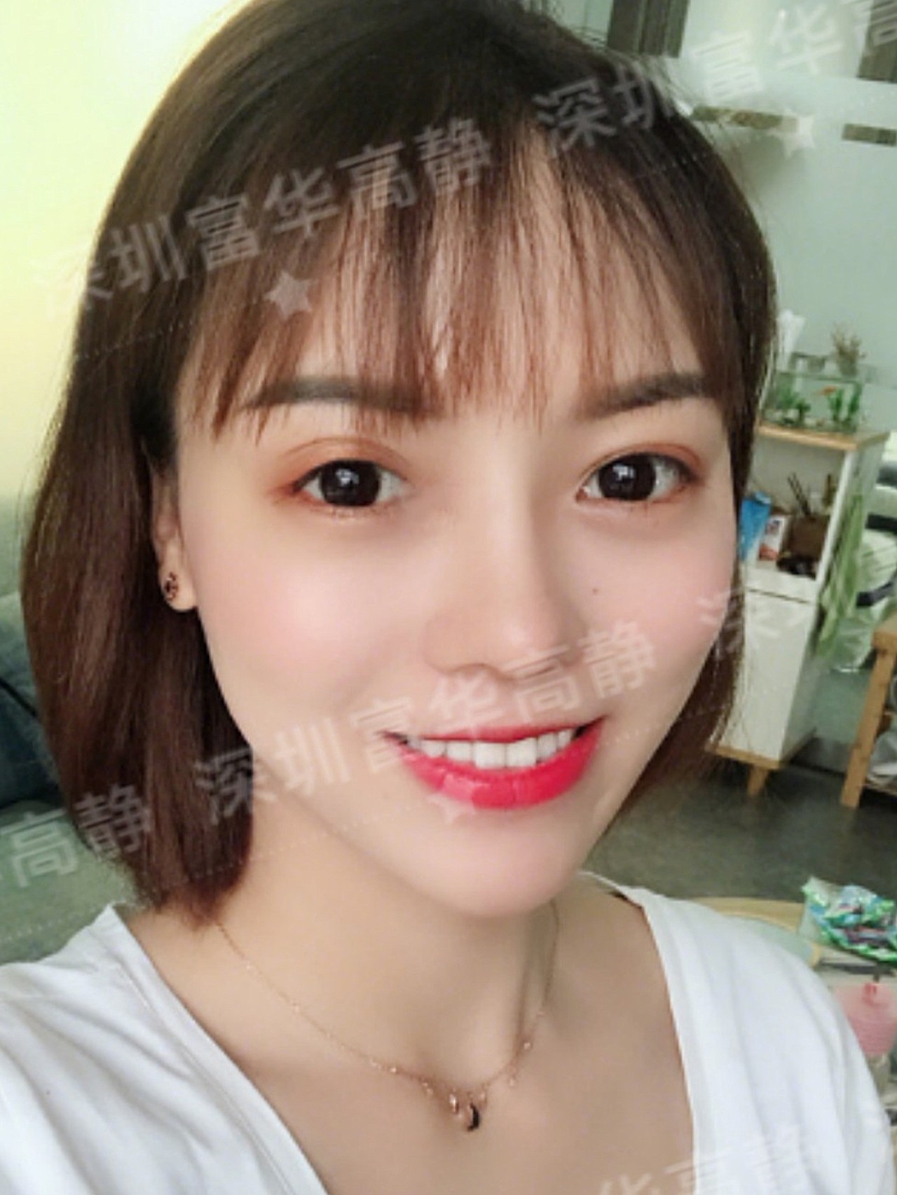 诊断术前小姐姐是属于经典的蒜头鼻,鼻梁宽且塌陷_圈子-新氧美容整形