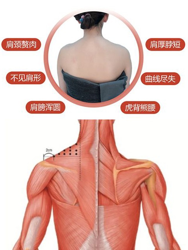 瘦肩针就是通过注射瘦肩针,让肩膀上发达的斜方肌软化