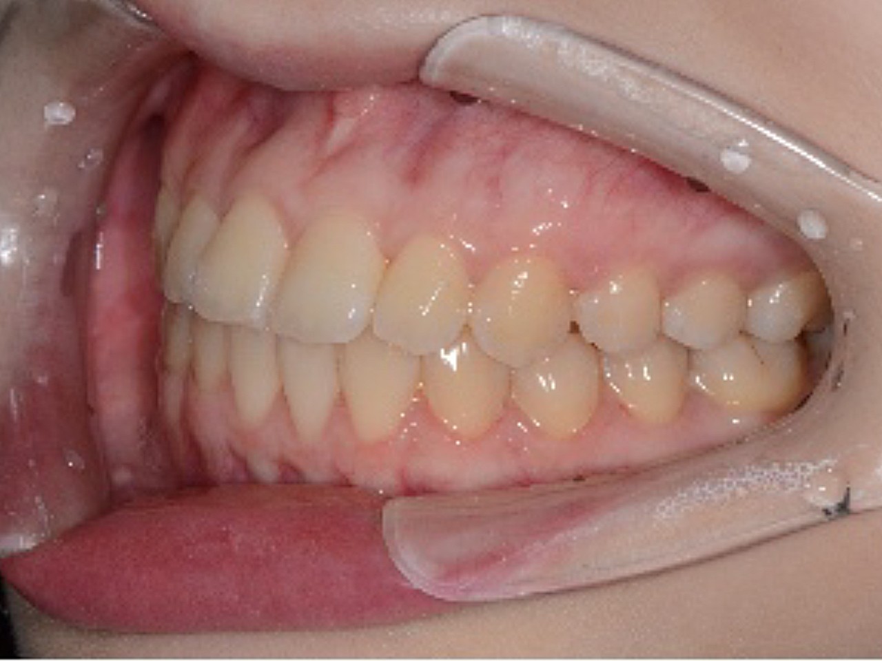 术前诊断患者术前牙齿咬合度不高,上下牙齿不齐,有几