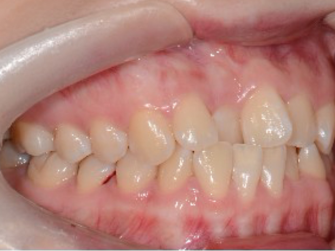 术前诊断患者术前牙齿咬合度不高,上下牙齿不齐,有几
