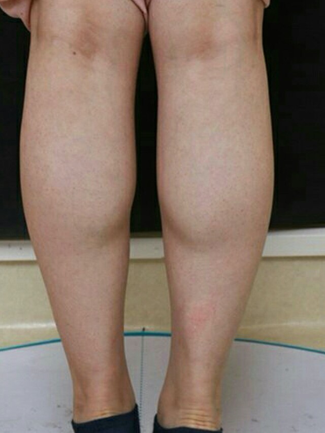 小腿有个肌肉疙瘩做了瘦腿针