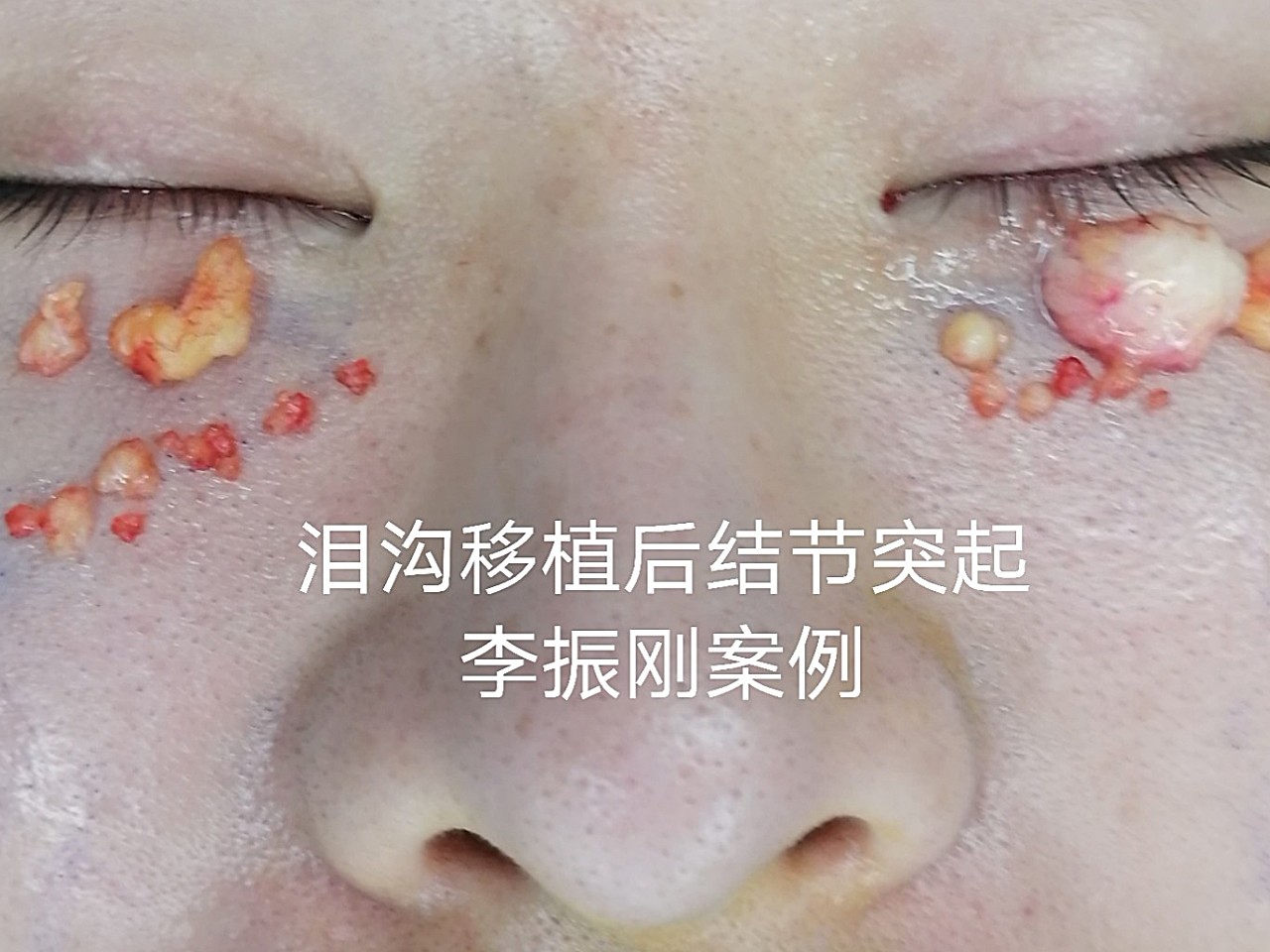 泪沟移植脂肪术后结节隆起