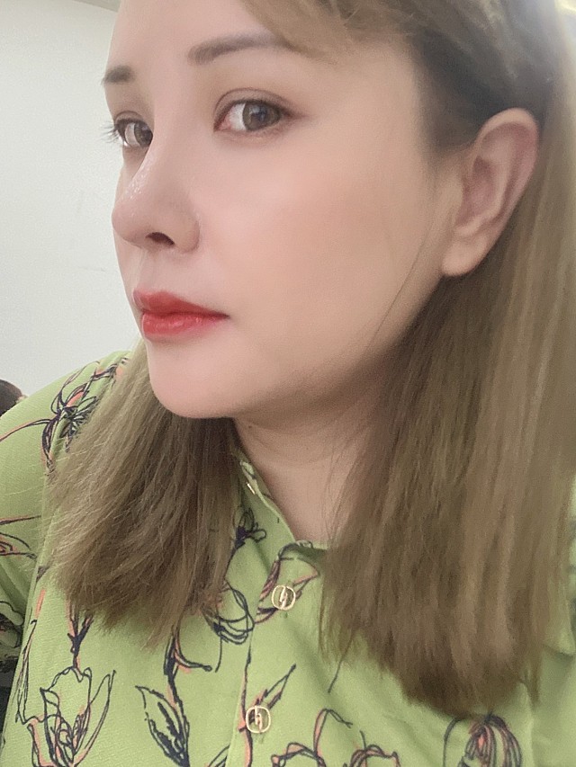 嘴巴现在恢复也是很自然啦,嘴角自然上翘的弧度和唇的_圈子-新氧美容