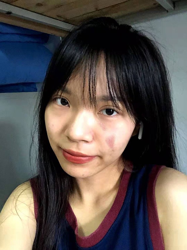 【激光祛疤术后18天】做离子束祛疤治疗有一段时间了_圈子-新氧美容