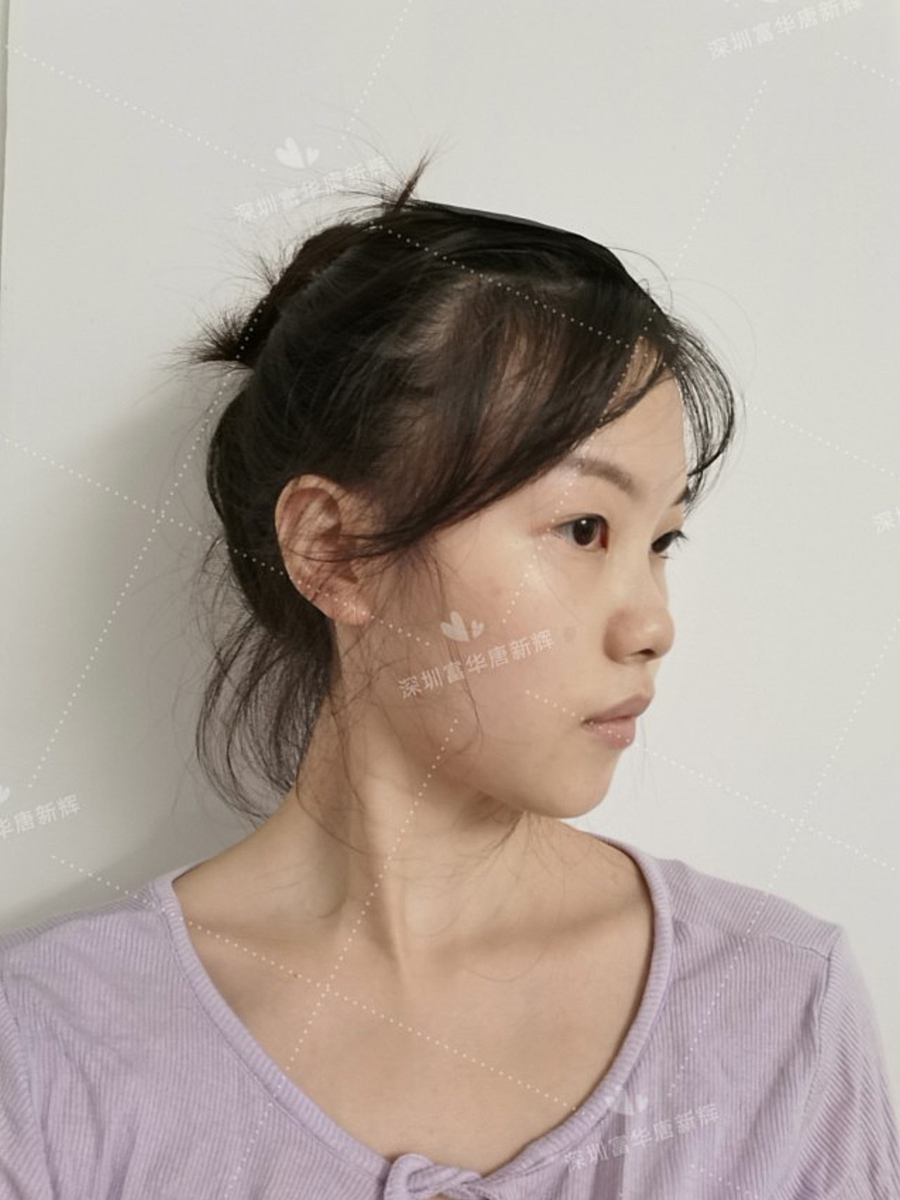 术前诊断术前患者mm山根低平,鼻梁塌陷没有弧度,整_圈子-新氧美容整形