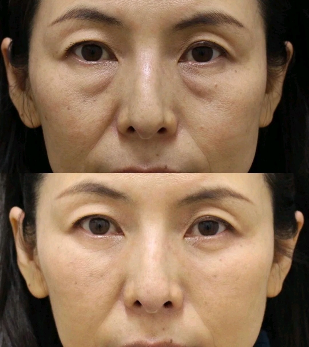 真假眼袋要怎么区分呢