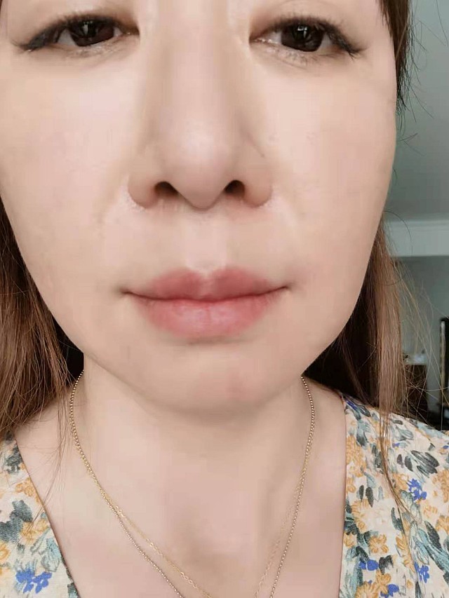 记录我的m唇,拆线后一周情况,嘴巴的形状相比之前好_圈子-新氧美容