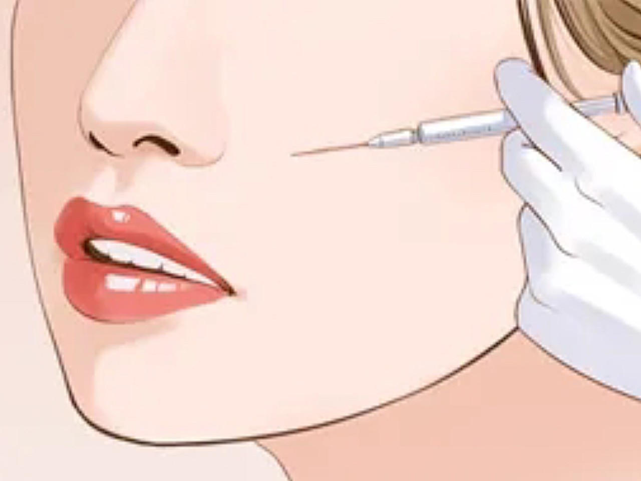 隆鼻手术卡通图片玻尿酸隆鼻动画注射隆鼻漫画注射鼻部肋软骨隆鼻后高