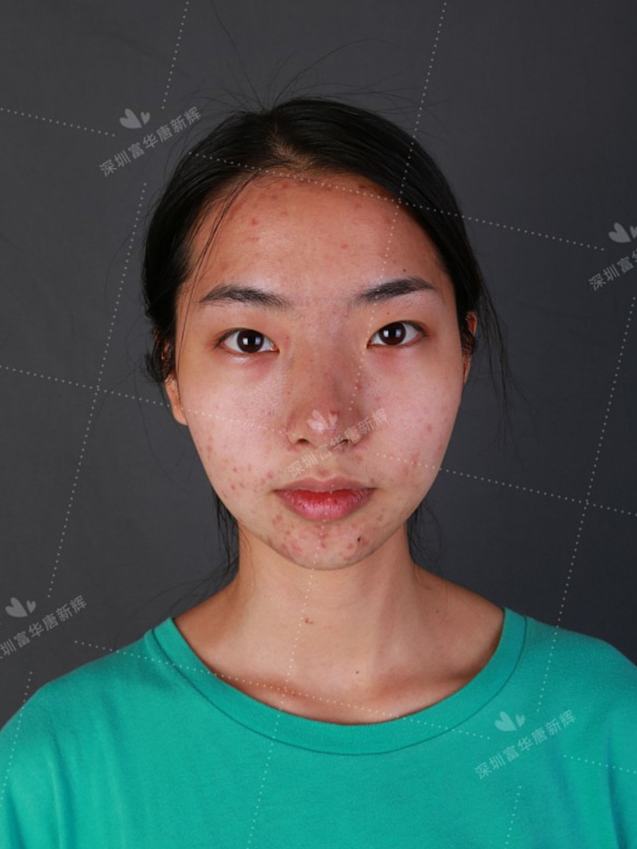 术前诊断术前患者山根低平,鼻梁没有弧度,轮廓感不