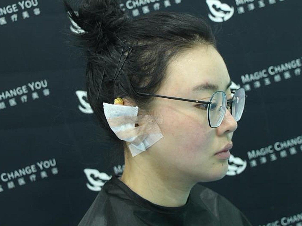 耳朵上包着纱布,因为才做完手术没多久嘛,所以目前看不到耳朵的恢复