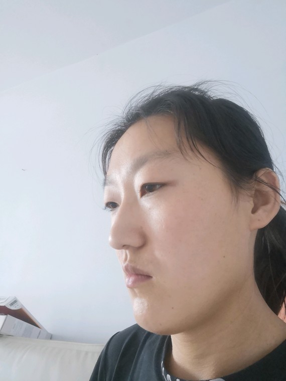 我为我的脸已经纠结好多年了,脸长,眼睛薄,颧骨高,_圈子-新氧美容整形