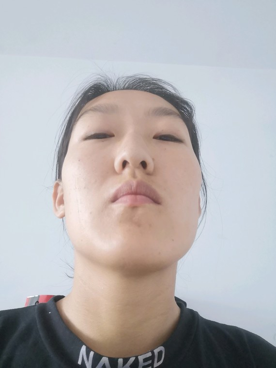 我为我的脸已经纠结好多年了,脸长,眼睛薄,颧骨高,_圈子-新氧美容整形
