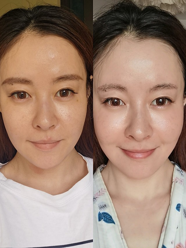 医美祛除红血丝