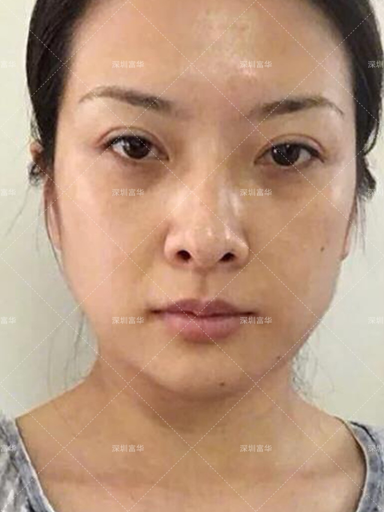 患者术前面部松弛苹果肌下垂