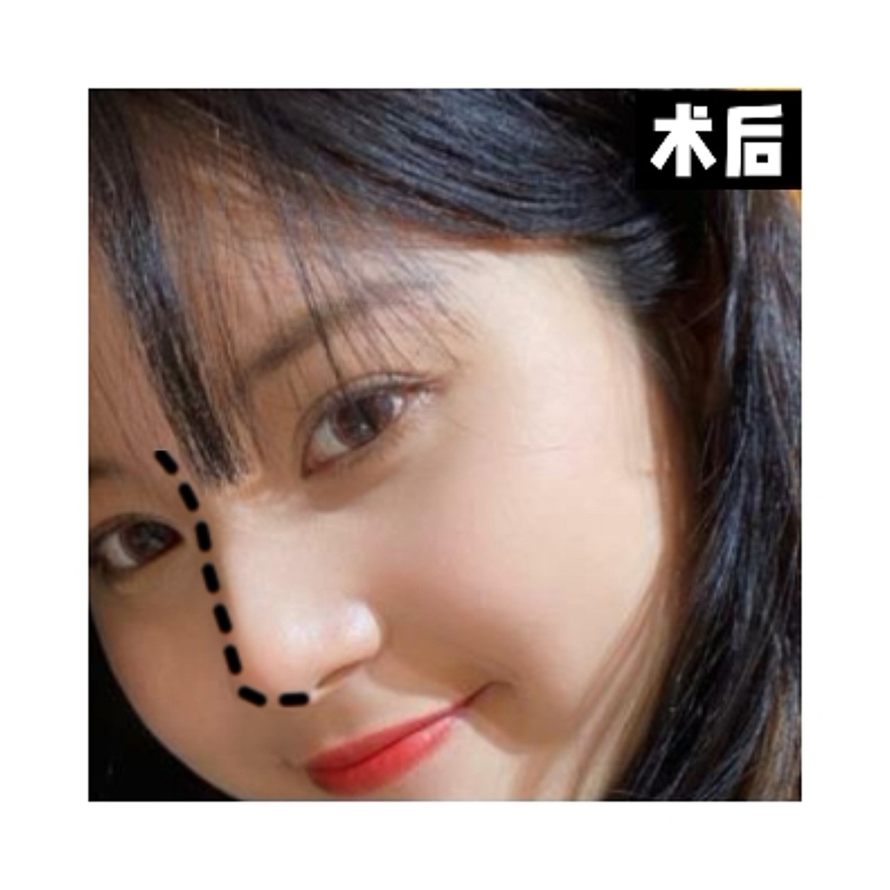 假体取出也不能阻止的鼻头挛缩你会中吗