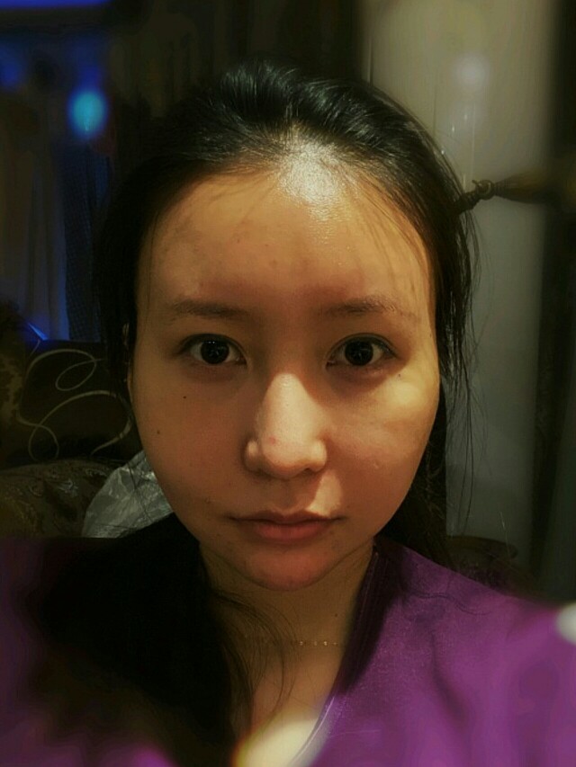 做面填半年来打卡,术前太阳穴,苹果肌,面颊凹陷没肉 圈子 新氧美容