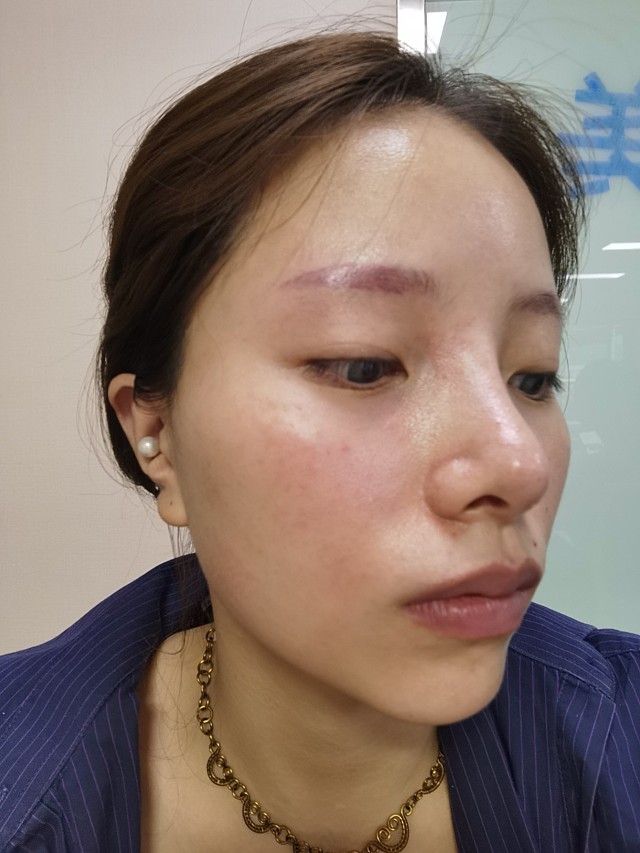 今天给大家带来伊肤泉微针操作第三天的效果哦