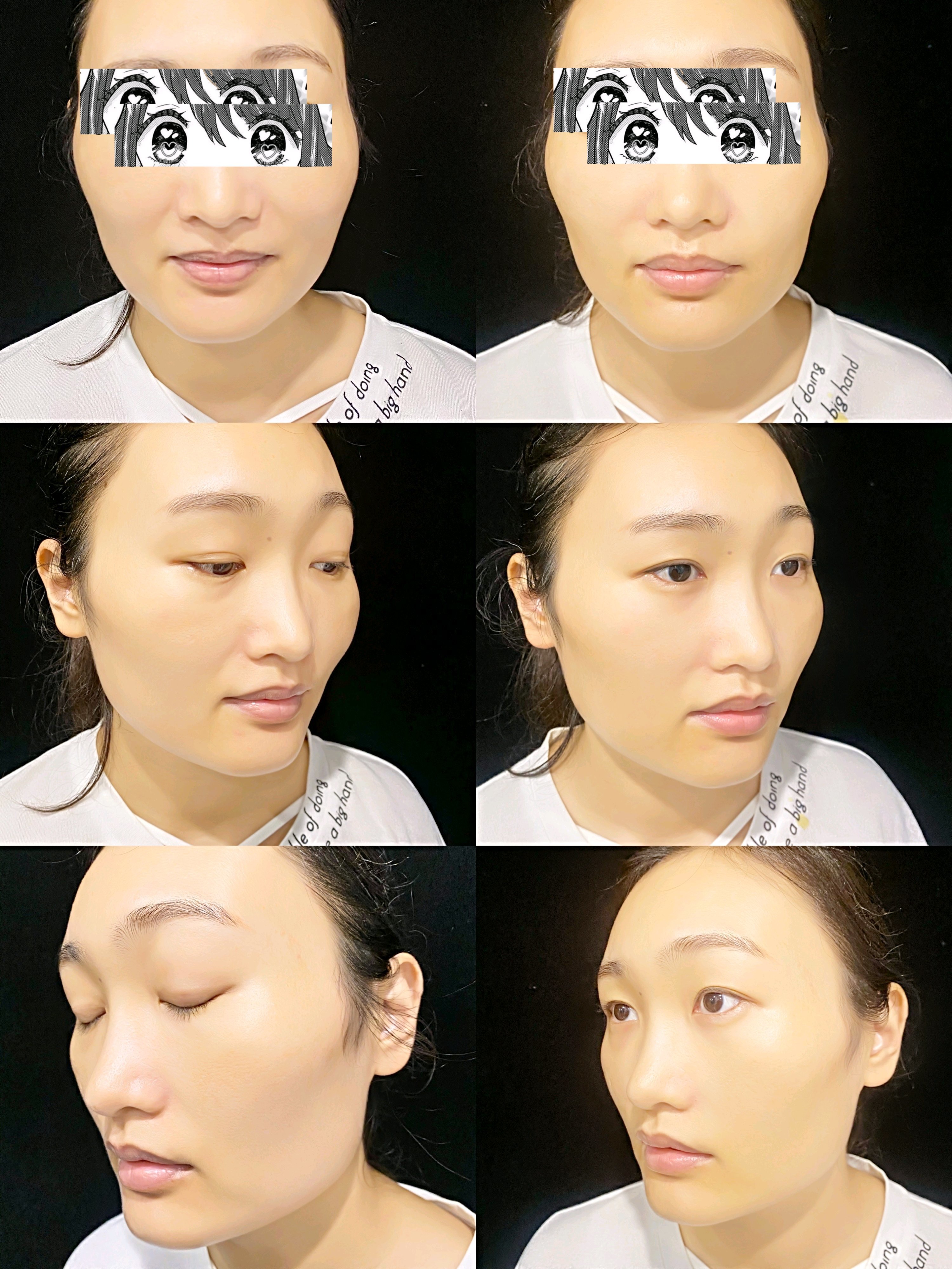 玻尿酸丰鼻基底