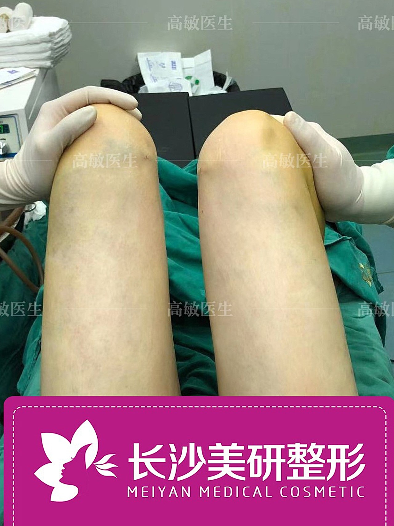 术前诊断该用户大腿脂肪堆积严重,内外侧脂肪很厚,顾_圈子-新氧美容