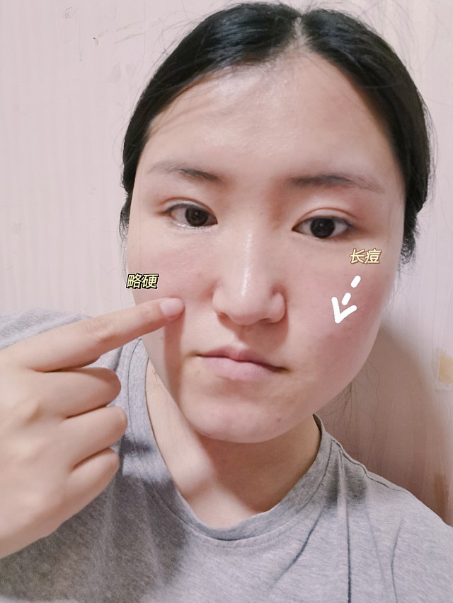玻尿酸本身是挺好的,从打的前几天就可以看出,稍微填平了脸上的俩坑