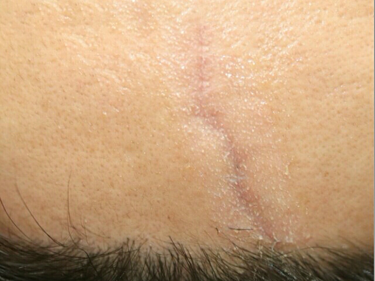 我的凹陷疤痕像不像闪电?呵呵!