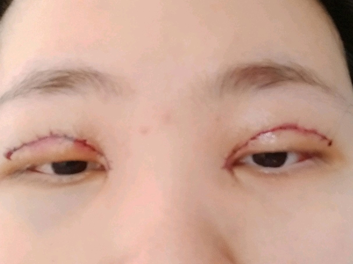 刚割完双眼皮眼睛睁不开会不会影响啊
