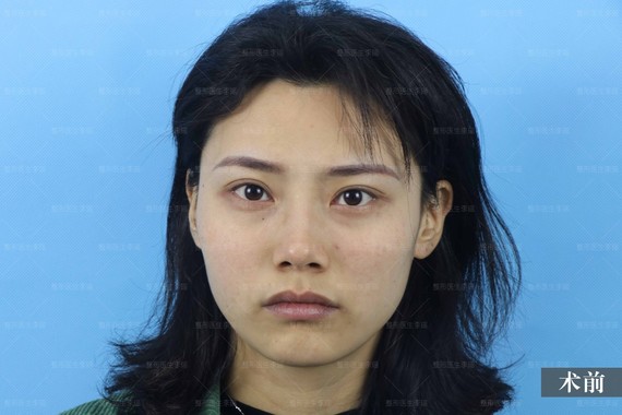 自体脂肪填充# #面部年轻化# #脂肪填充