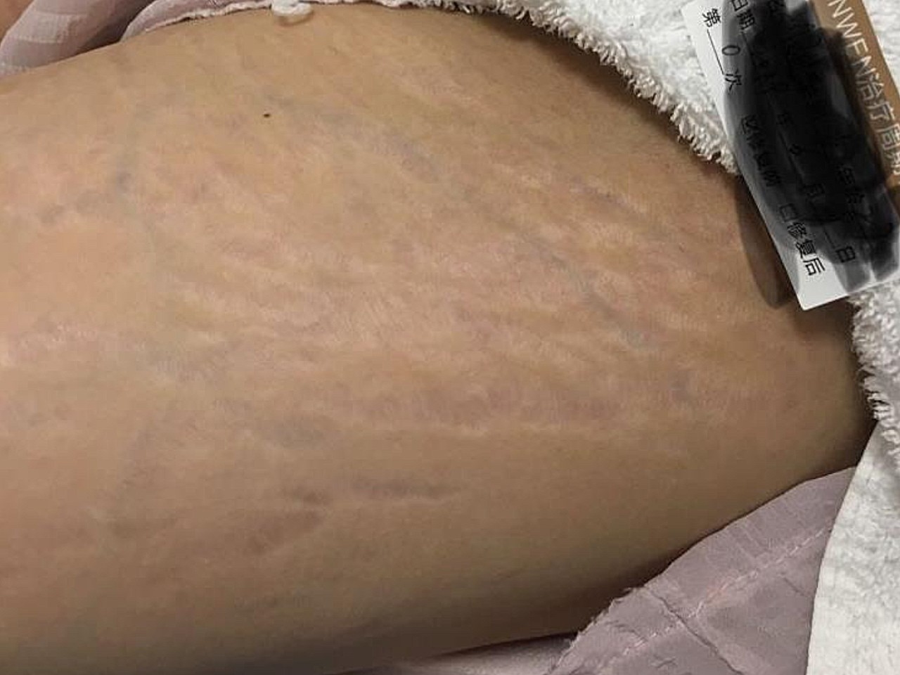 [:163]体验前变美诉求:我的激素纹伴随我六年了_圈子-新氧美容整形