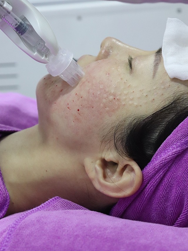 注射完羽美童颜长效水光后半个月后啦现在我就来说说这半个月的恢复和