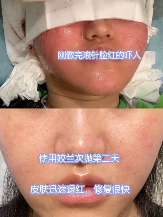 滚针后如何修复皮肤