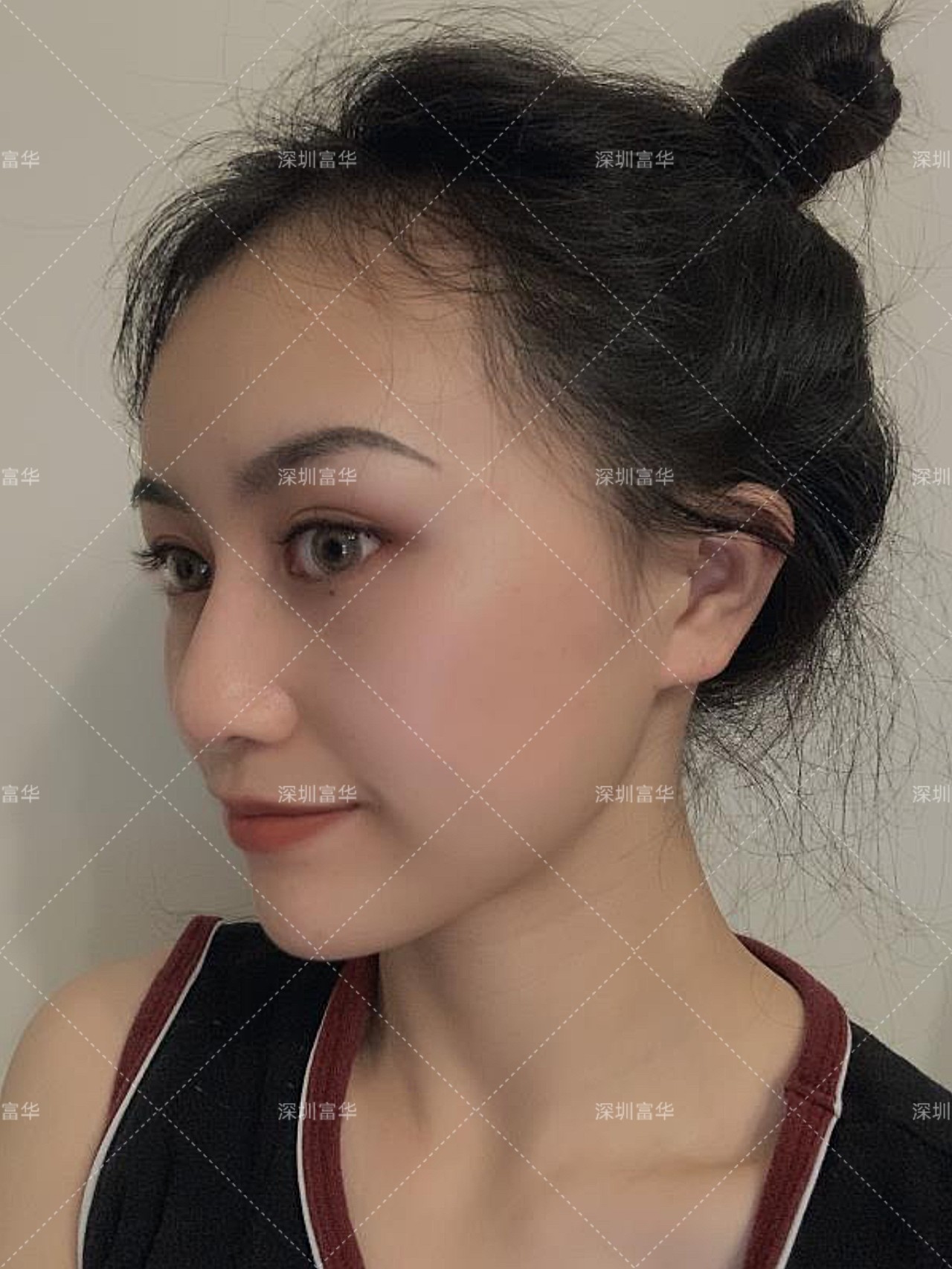 术前患者鼻翼宽大鼻基底凹陷