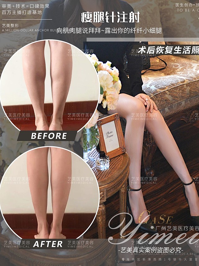 艺美74瘦腿针注射瘦小腿07从小姐姐反馈的对比照,瘦腿_圈子-新氧