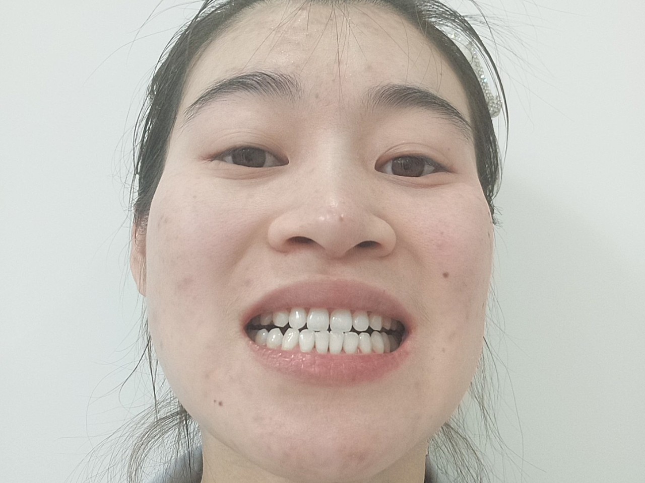 体验前变美诉求:一直觉得自己牙齿不好看,基本很少有露牙齿的照片