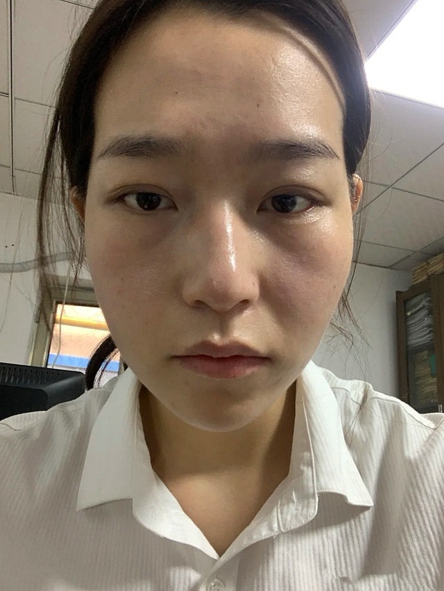 29岁的法令纹这么重,简直哭了,玻尿酸填充效果立现_圈子-新氧美容整形