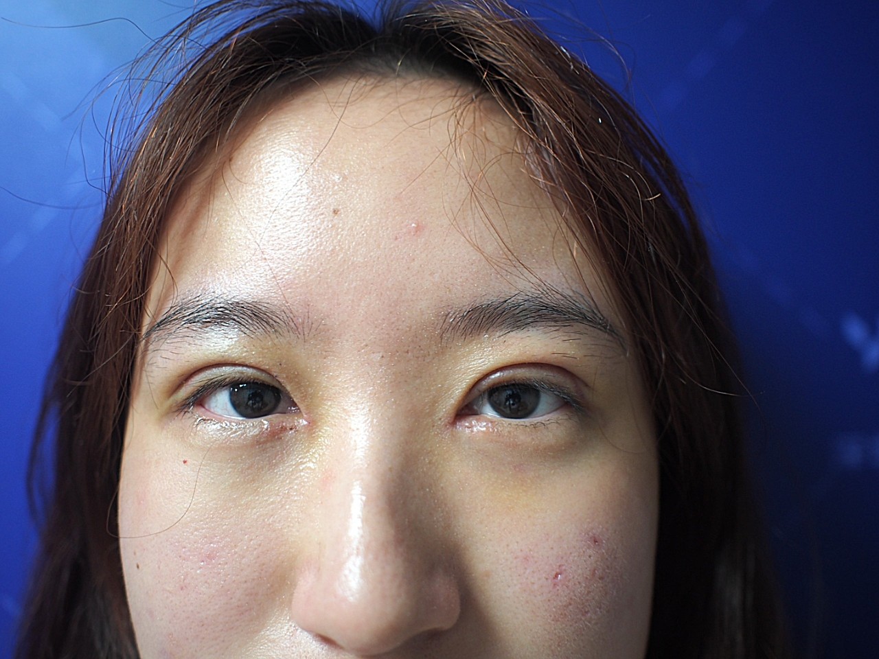 术前诊断术前诊断:单眼皮,内呲赘皮,轻度上睑下垂,_圈子-新氧美容整形