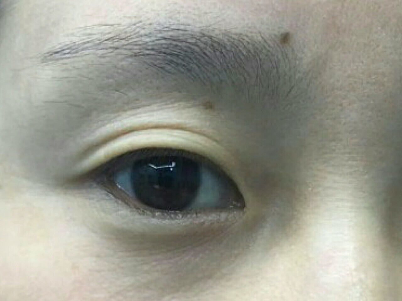 眼皮褶皱松弛,眼角下垂,眼无神,肌无力 【手术方案】:全切双眼皮 祛皮