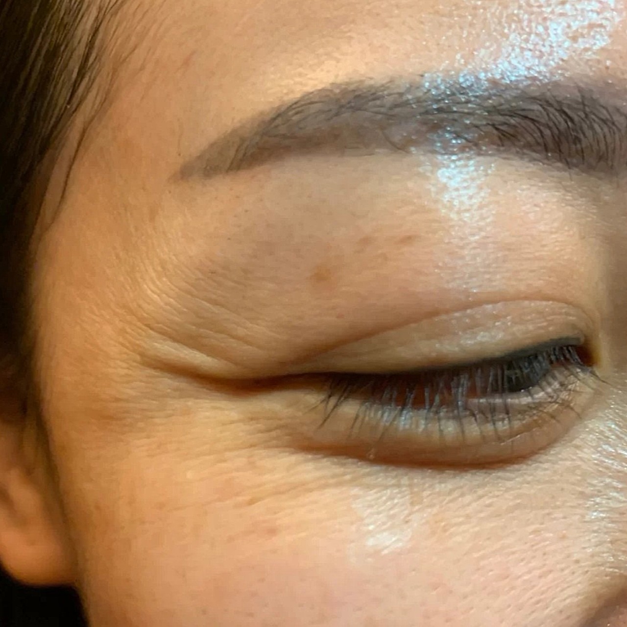 体验前变美诉求:可能是上了年纪的缘故,我眼尾的鱼尾纹比较明显,感觉