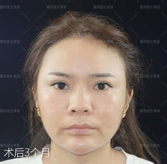 面部整形案例大pk这个美女太阳穴额头凹陷,苹果肌_圈子-新氧美容整 